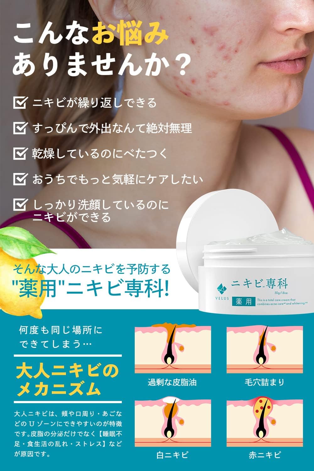 VELUS лекарство от угревой сыпи Senka gel Уход за кожей спины и всего тела для профилактики угревой сыпи, 50 г квазинаркотического геля для тела, фото 3
